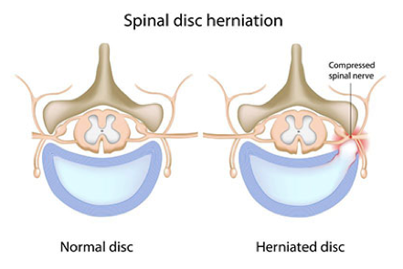 Herniated Discs Causes & Treatments