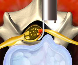 Endoscopic Microdiscectomy - Endoscopic Disc Surgery (EDS)