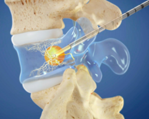 Intracept Procedure For Chronic Pain