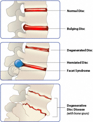 Degenerative Disc Disease Causes Treatments